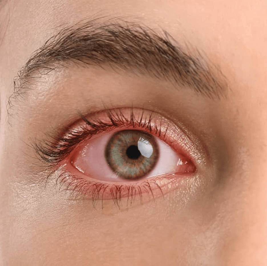 Social Determinants Impact Microbial Keratitis Treatment Access